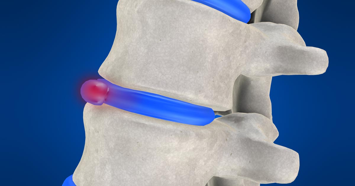 Spinal decompression therapy in Tucson